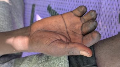 A close-up of a hand with blackened fingertips resting on a purple and gray surface.